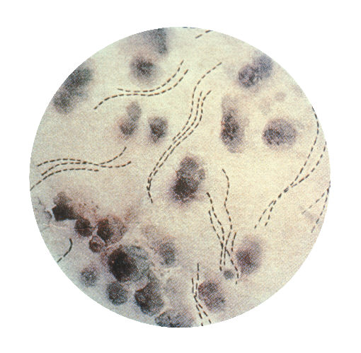 Hemophilus ducreyi