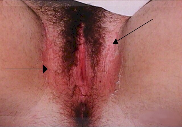 Two holes inside vagina and discoloration