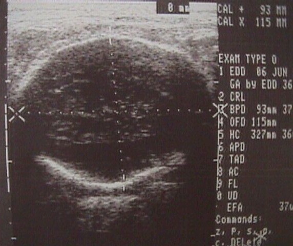 Bpd And Fl Chart In Pregnancy