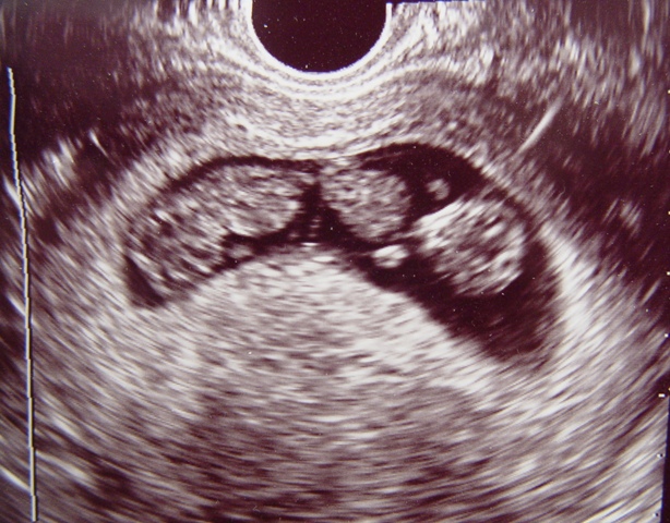 When do twins show up on ultrasound