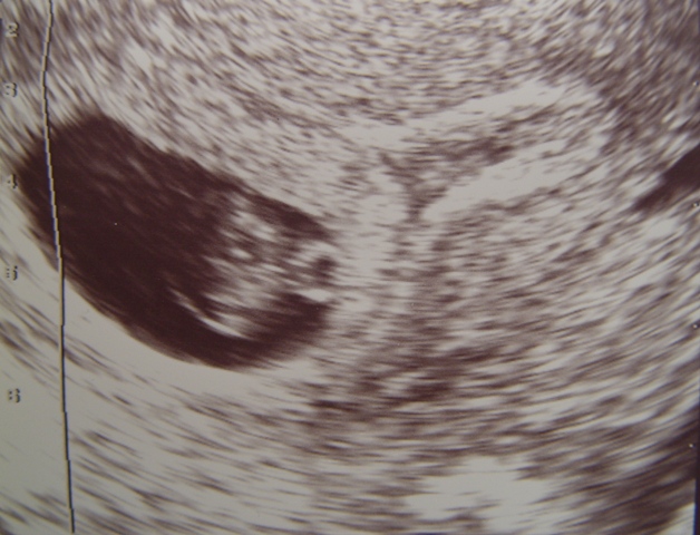 Mean Sac Diameter Gestational Age Chart