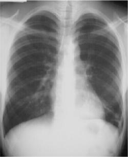 lll pneumonia post segment pa