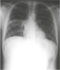 rll sup segment pneumonia