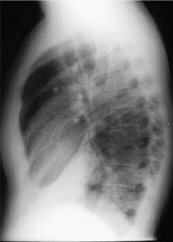 rll pneumonia ant segment lat