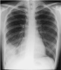 rll pneumonia ant segment pa
