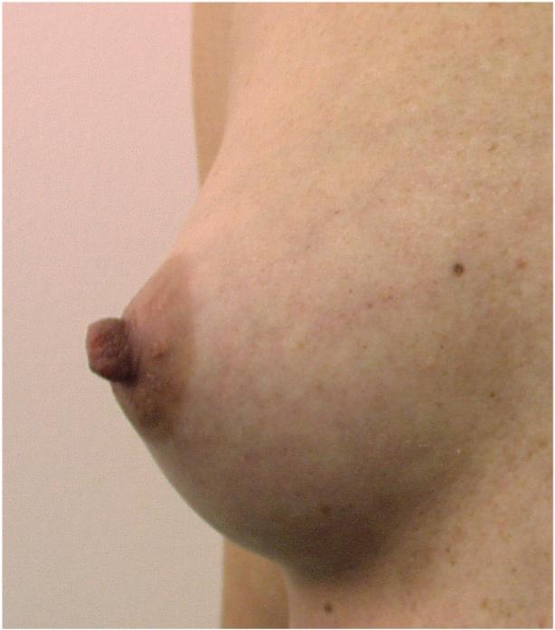 Normal Everted Nipple