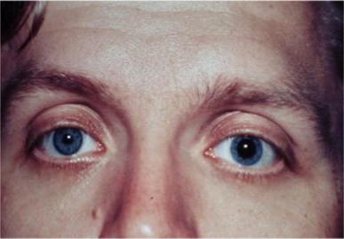 Сотрясение глаза. Перелом основания черепа симптом очков.