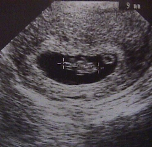 1st Trimester Ultrasound Scanning