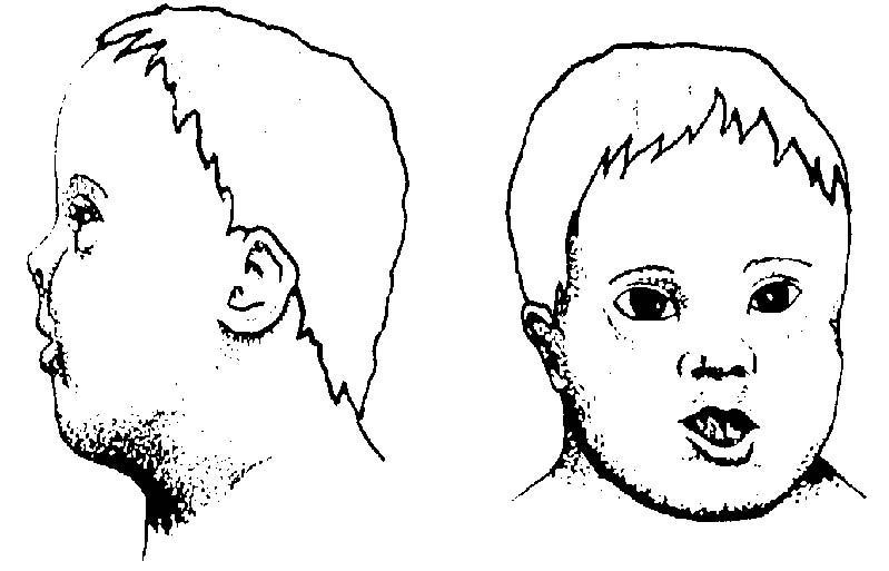 Голова дауна. Форма головы у детей с синдромом Дауна. Переносица у детей с синдромом Дауна. Плоское лицо. Лицо ребенка с синдромом Дауна.
