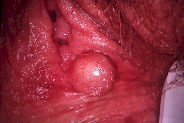 Epithelial Inclusion Cysts Of Vulva