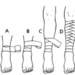 Figure 2-27. Applying a reverse spiral bandage to a lower leg.