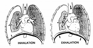 Figure 3-11. Tension pneumothorax resulting from a closed chest injury.