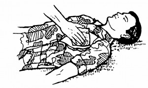 Figure 3-3. Applying sealing material to an open chest wound.