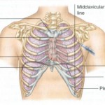 Figure 3-7. Needle position on the mid-clavicular line above the third rib.