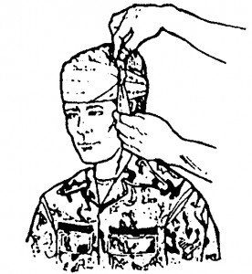 Figure 5-3. Tying the tails on the side of the head (wound on forehead).