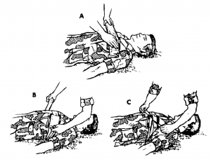 Figure 3-5. Applying a field dressing to an open chest wound.