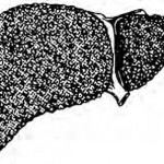Figure 3-13. Typical alcoholic cirrhosis of the liver.