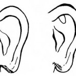 Figure 4-4. Laceration/repair of the earlobe.