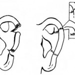 Figure 4-6. Laceration/accurate alignment repair of external ear.
