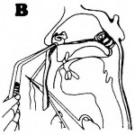 Figure 4-9. Insertion of anterior-posterior nasal pack (continued).