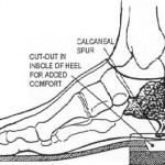 Figure 2-8. Calcaneal spur syndrome.