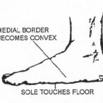 Figure 2-9. Pes planus (flatfoot).
