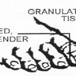 Figure 2-11. Ingrown toenail.
