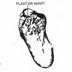 Figure 2-12. Plantar wart.
