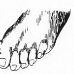 Figure 2-14. Pes cavus (clawfoot).