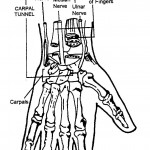 Figure 1-2. Carpal tunnel syndrome.