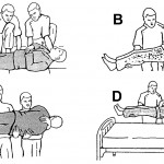 Figure 2-23. Lifting patient from floor to bed.