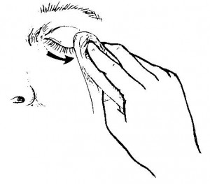 Figure 1-5. Bathing the eyelids.