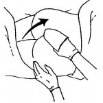 Figure 4-3. Place sterile drape under buttocks.
