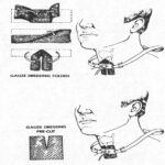 Figure 2-6. Tracheostomy dressing.