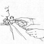 Figure 2-5. Tracheostomy suctioning.