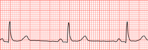 Sinus Bradycardia. By Sinusbradylead2.JPG: James Heilman, MD derivative work: Mysid (using Perl and Inkscape) (This file was derived from  Sinusbradylead2.JPG:) [CC BY-SA 3.0 (http://creativecommons.org/licenses/by-sa/3.0) or GFDL (http://www.gnu.org/copyleft/fdl.html)], via Wikimedia Commons