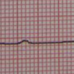 Complete Heart Block (Third-Degree). By James Heilman, MD (Own work) [CC BY-SA 3.0 (http://creativecommons.org/licenses/by-sa/3.0)], via Wikimedia Commons