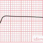 De-Rhythm idioventricular (CardioNetworks_ECGpedia)By CardioNetworks: Googletrans (CardioNetworks: De-Rhythm_idioventricular.png) [CC BY-SA 3.0 (http://creativecommons.org/licenses/by-sa/3.0)], via Wikimedia Commons