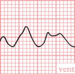 De-Rhythm_ventricular_fibrillation_(CardioNetworks_ECGpedia). By CardioNetworks: Googletrans [CC BY-SA 3.0 (http://creativecommons.org/licenses/by-sa/3.0)], via Wikimedia Commons