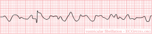 De-Rhythm_ventricular_fibrillation_(CardioNetworks_ECGpedia). By CardioNetworks: Googletrans [CC BY-SA 3.0 (http://creativecommons.org/licenses/by-sa/3.0)], via Wikimedia Commons