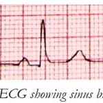 ECG showing sinus bradycardia.