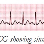 ECG showing sinus tachycardia