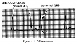 Figure 1-11. QRS complexes