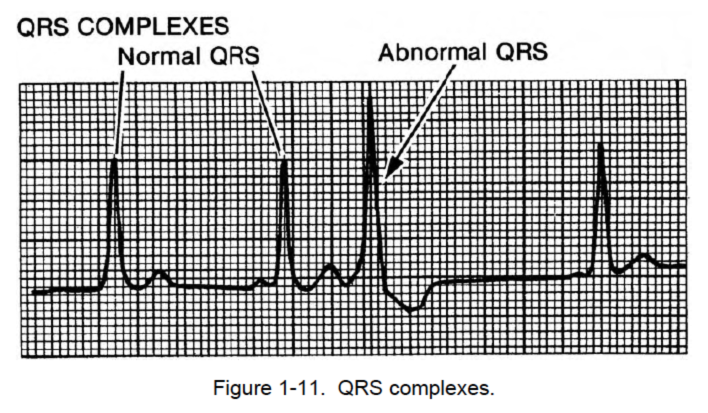 normal qrs time