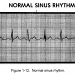 Figure 1-12. Normal sinus rhythm