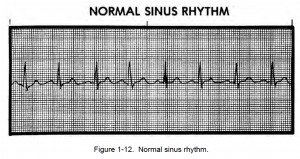 Figure 1-12. Normal sinus rhythm
