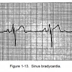 Figure 1-13. Sinus bradycardia