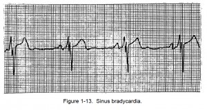 Figure 1-13. Sinus bradycardia