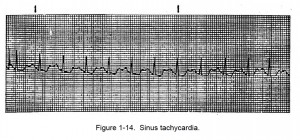 Figure 1-14. Sinus tachycardia