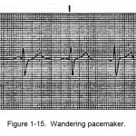 Figure 1-15. Wandering pacemaker